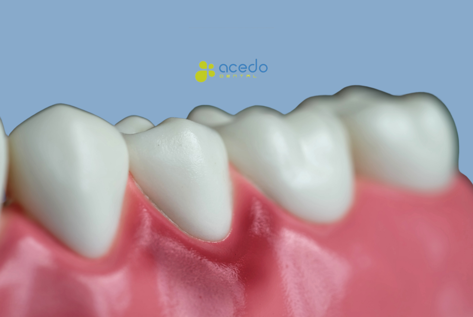 gingivitis