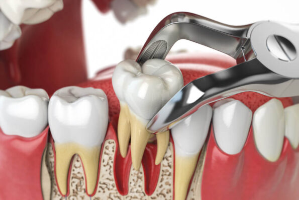 extracción dental